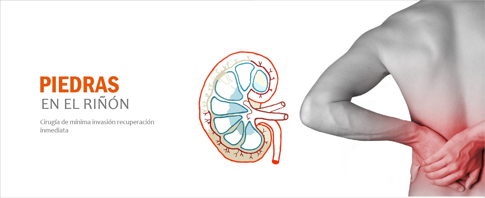 Urología laparoscopia